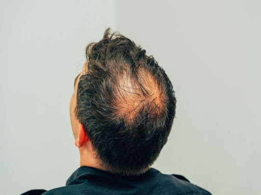 Perda de cabelo é o atributo físico que mais afeta a autoestima