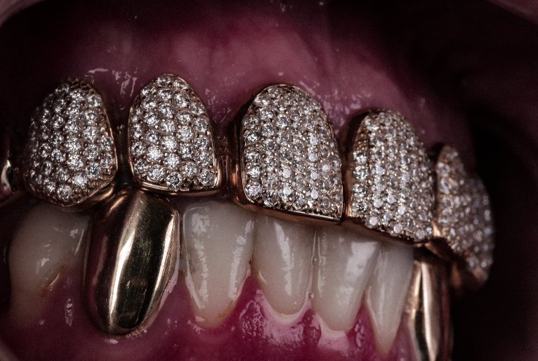 De grillz a piercings: especialista explica cuidados necessários com acessórios bucais