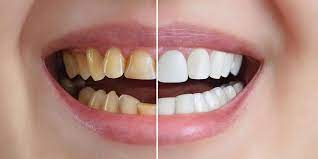 Facetas dentárias corrigem variações de cores dos dentes e resolvem problemas estéticos do sorriso
